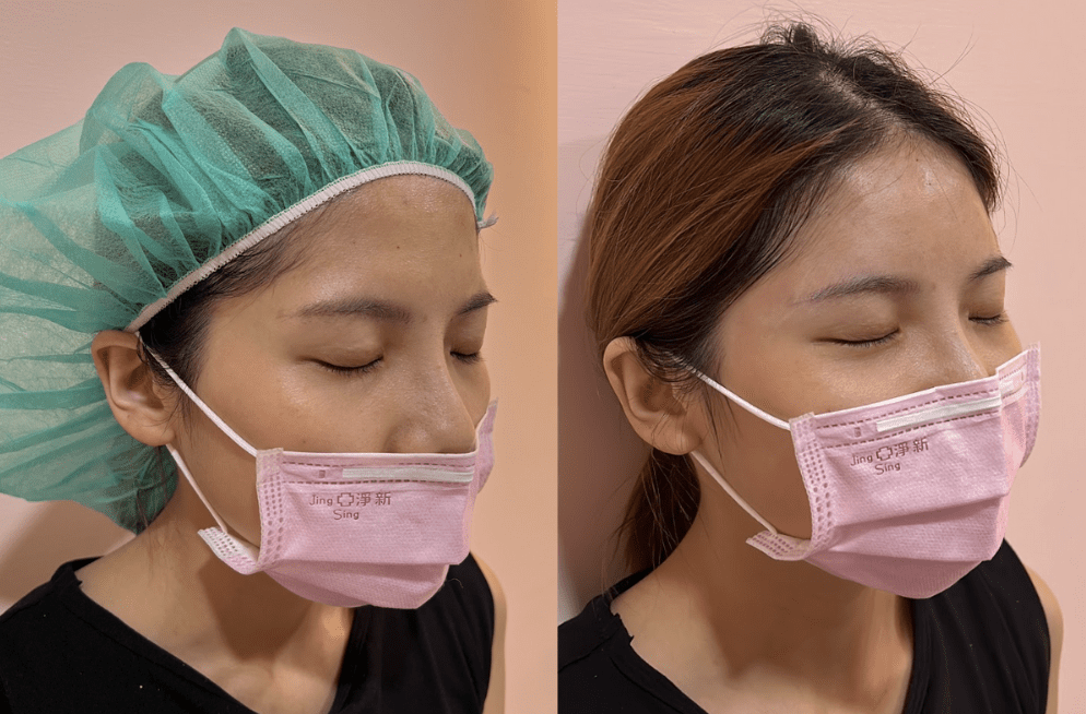 Ellanse forehead augmentation