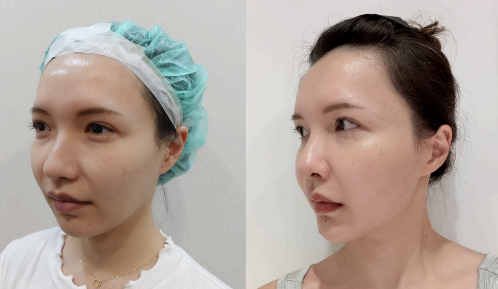 Radiesse chin case, side-profile comparison improving a receding chin contour