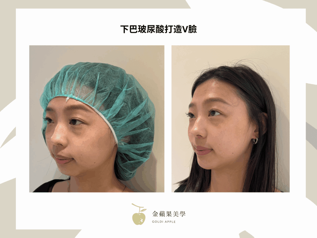 How long chin hyaluronic acid lasts