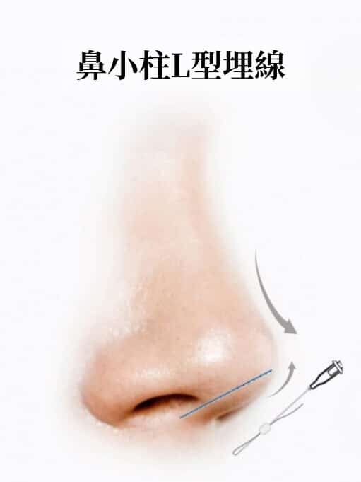 Diagram of 'L-shaped columella thread': the thread is placed through the columella to support the nasal tip